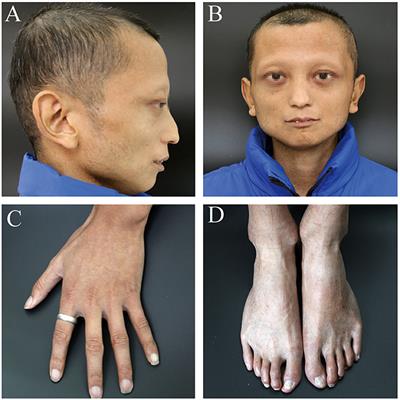 Cerebral Haemorrhage in a Young Patient With Atypical Werner Syndrome Due to Mutations in LMNA